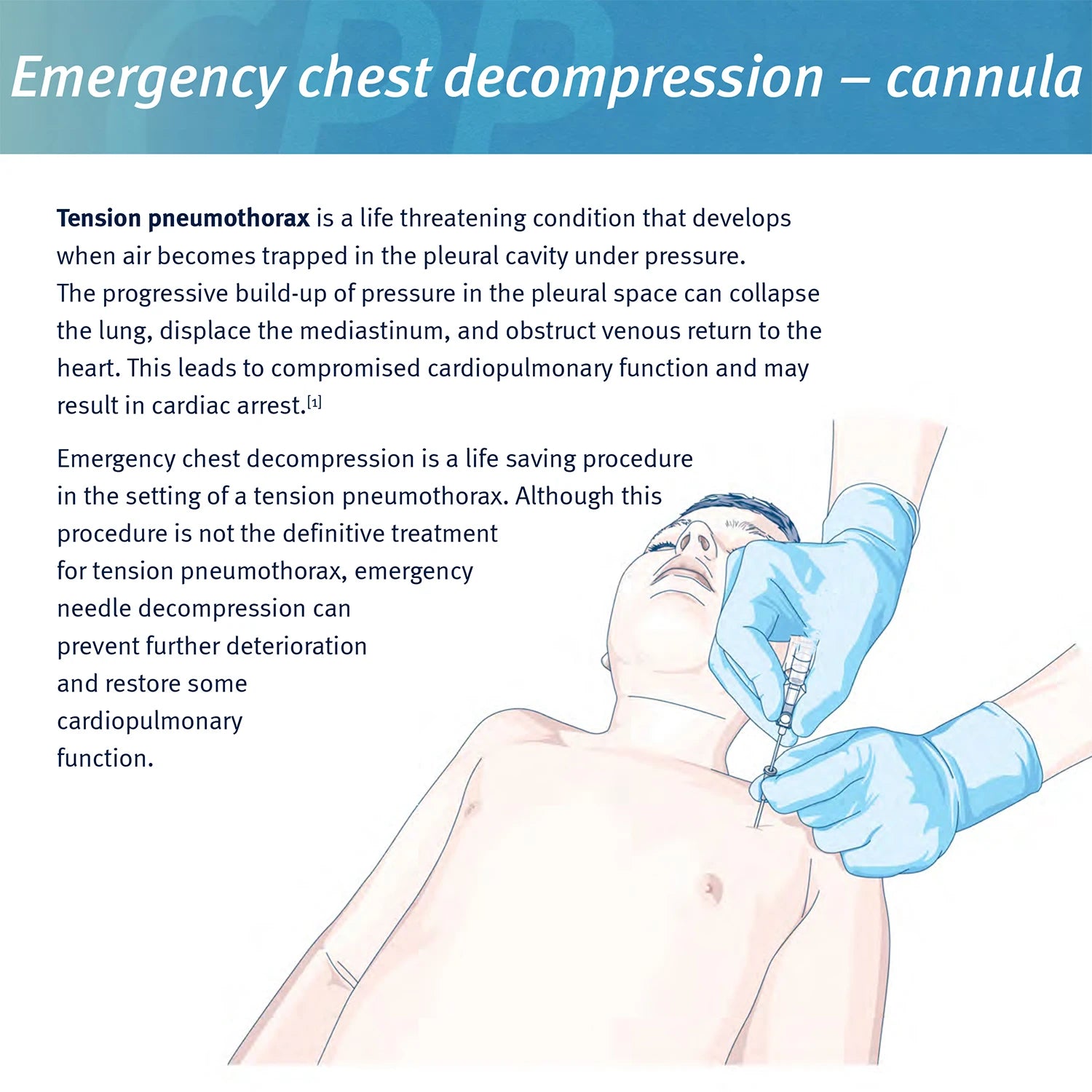 Kit Médical de Décompression pour Pneumothorax avec Aiguille Sanke - 14ga 50g - Catheter de Décompression d'Urgence (IFAK) - BLACKBEARD OUTDOOR INDUSTRIES